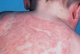 , Vi&ecirc;m da cơ địa Atopic Dermatitis